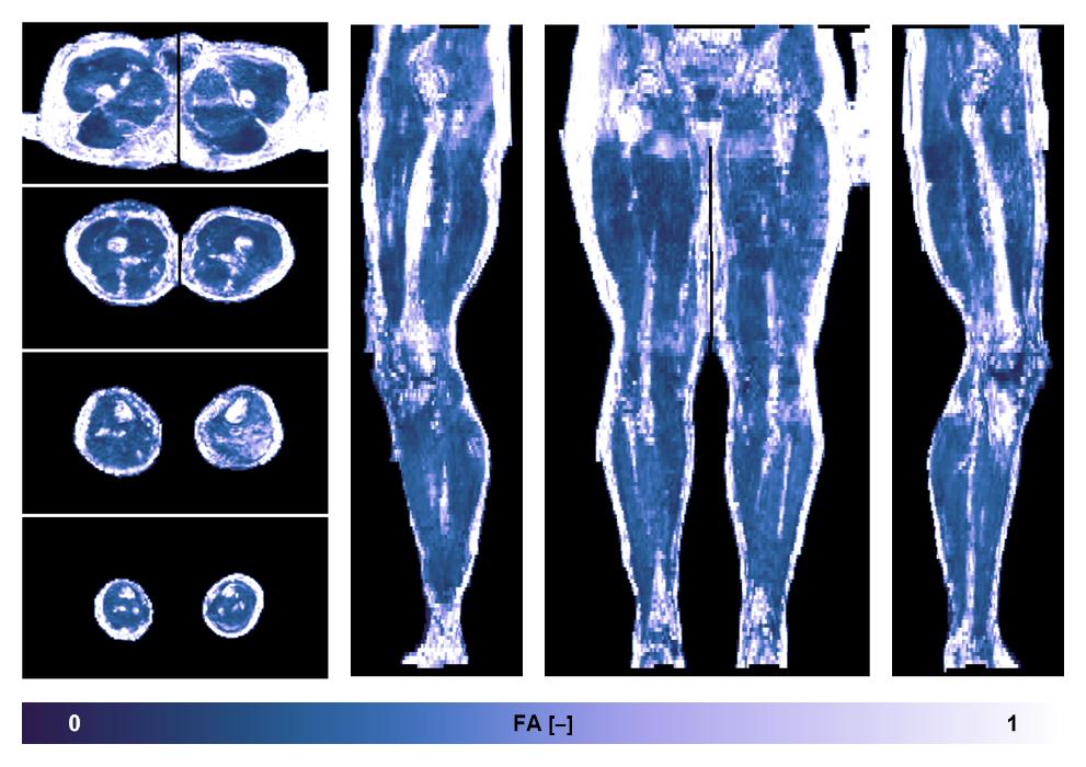 IVIM corrected whole leg muscle fractional anisotropy obtained from diffusion tensor imaging.